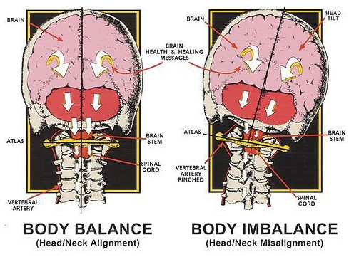 “Diagram comparing a healthy upper cervical spine alignment versus a misaligned atlas and axis, showing effects on brainstem, vertebral artery, and nerve function in relation to upper cervical chiropractic care.